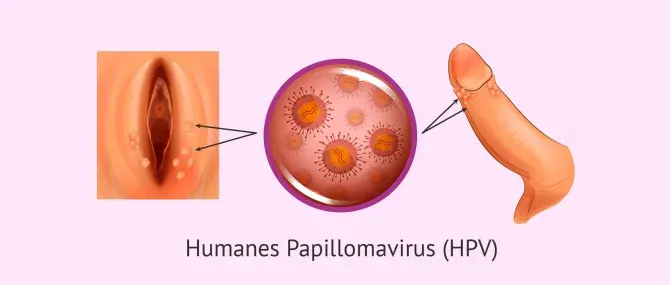 HPV (Human Papilloma Virus )