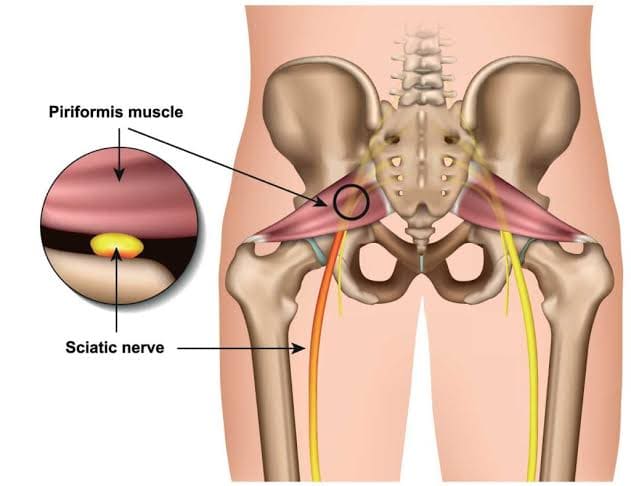 SINDROMA PIRIFORMIS